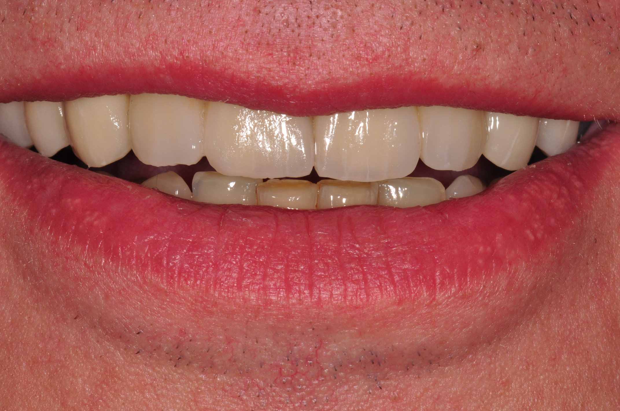 Komplettbehandlung in Sedierung in nur 2 Terminen mit Vollkeramik (das Bild wirkt etwas dunkel; wir basteln aber an den Fotos nicht herum)